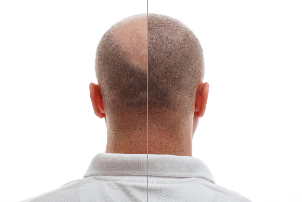 Boost Confidence Hair Restoration Insights