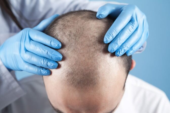 The Journey of a Successful Hair Transplant