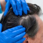 the science behind hair transplants