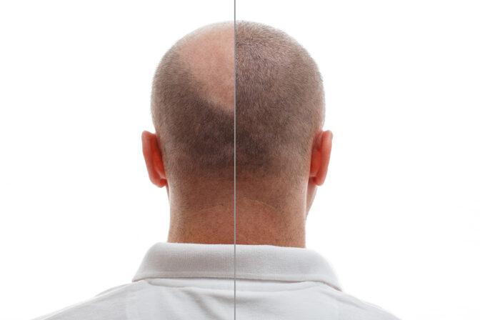 Hair Transplantation: A Quick Overview