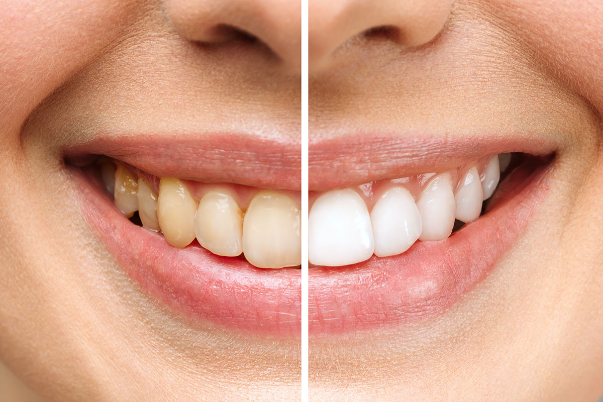 The Benefits of Professional Teeth Whitening