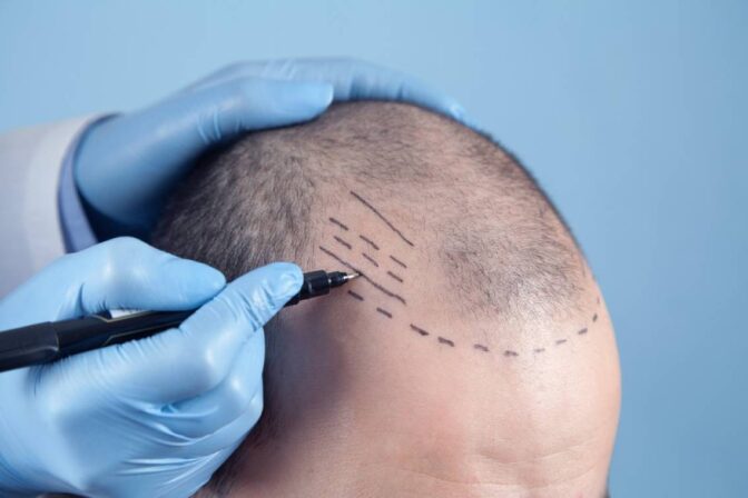 Hair Transplant Myths: What’s True and What’s Not?