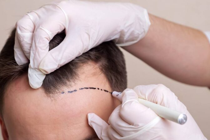 How Hair Transplantation Can Boost Your Confidence