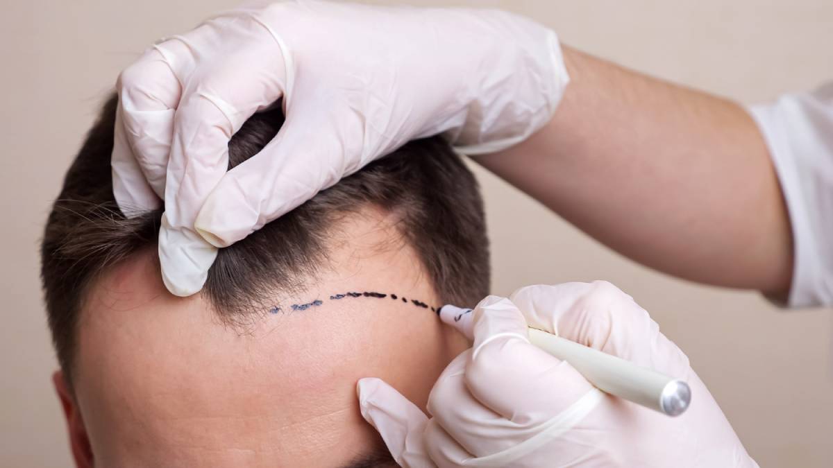 How Hair Transplantation Can Boost Your Confidence