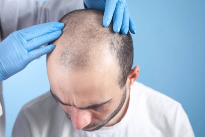 Is Hair Transplantation Right for You?