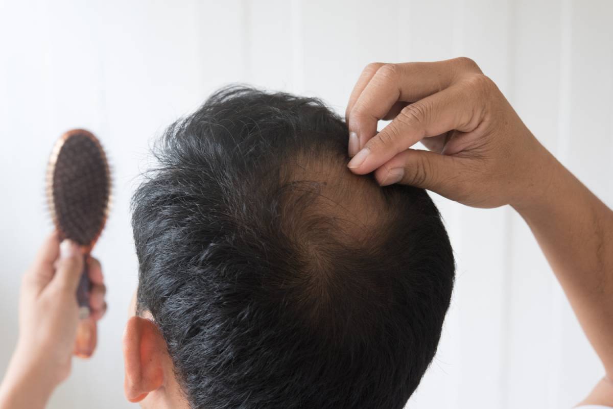Hair Transplantation: The Key to a Fuller, Healthier Hair