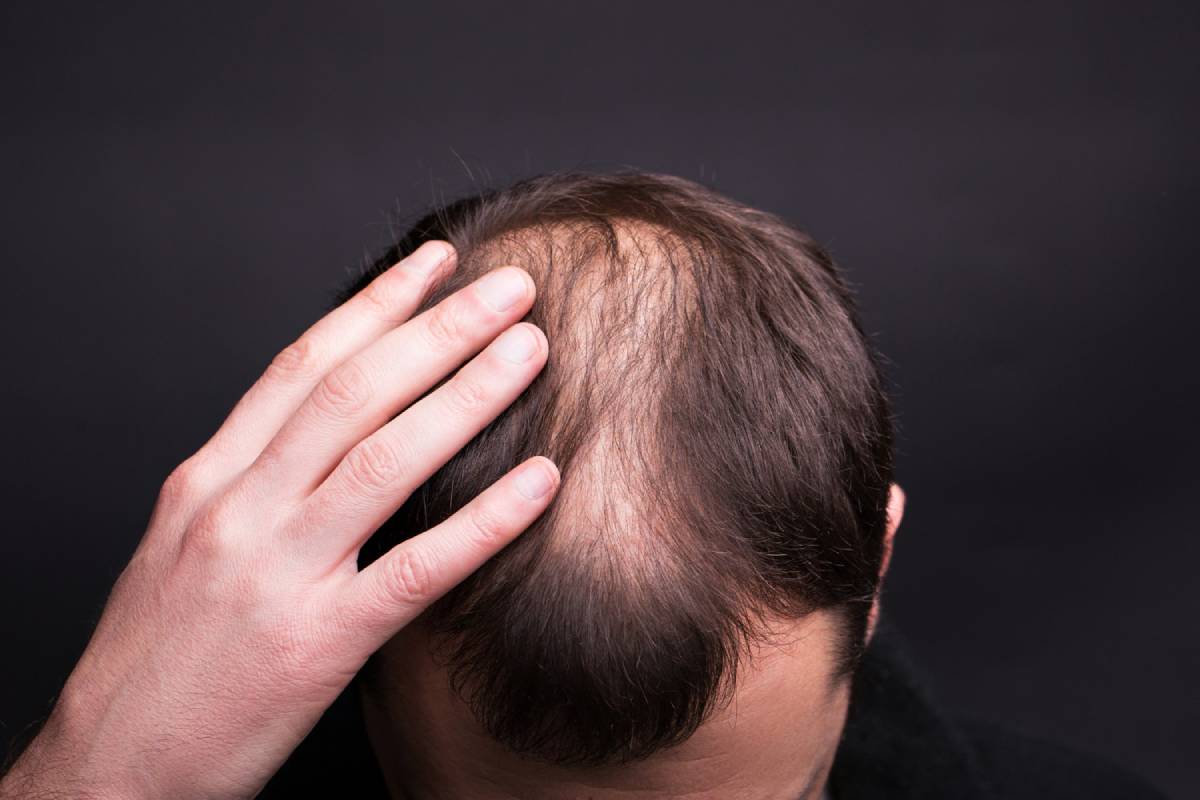 The Benefits of Hair Transplantation for Thinning Hair