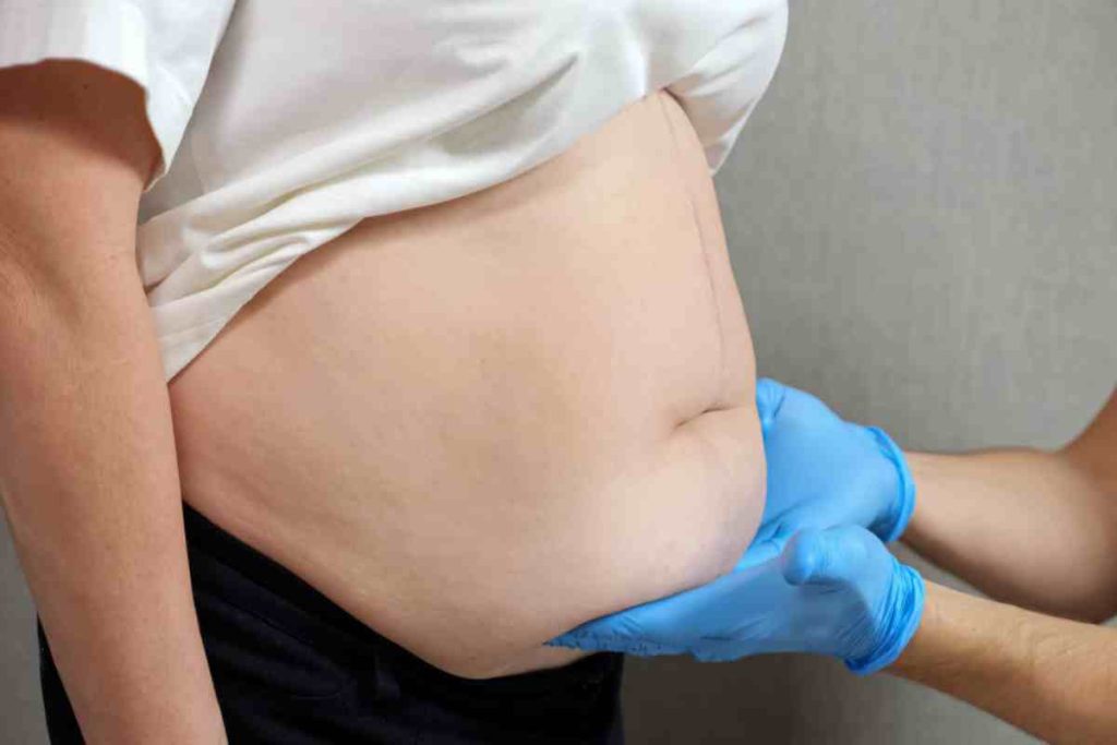 Life After Obesity Surgery: What to Expect