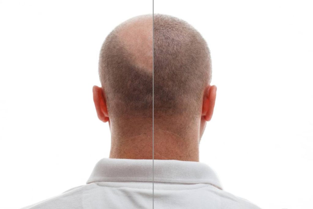 The Truth Behind Hair Transplantation: What You Should Know