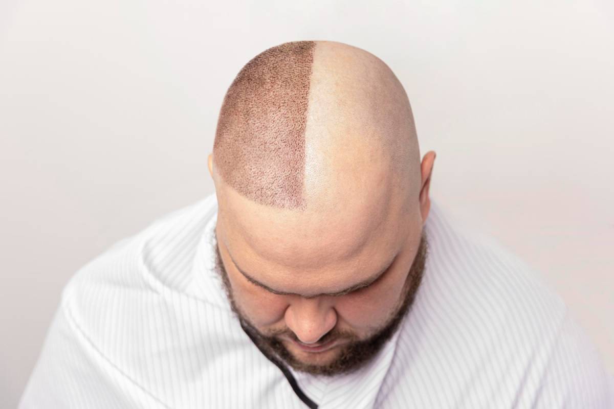Regain Your Confidence Through Hair Transplantation
