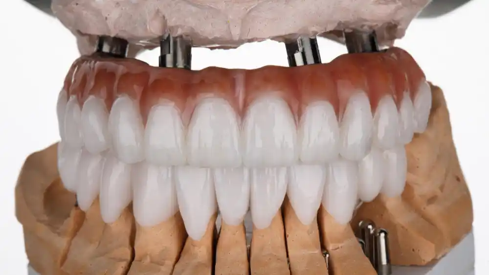 All-on-4 Dental Implants: A Permanent Solution for Full-Mouth Restoration